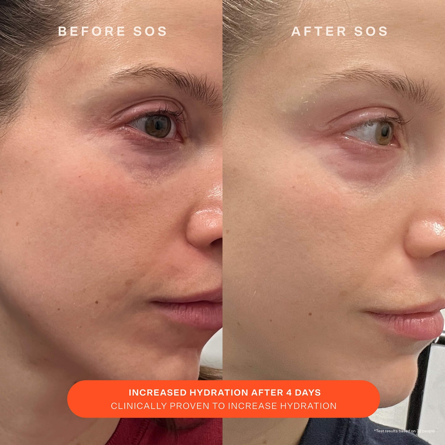 [Shared: A comparison before and after the use of Tower 28 Beauty SOS Recovery Cream. "Increased hydration after 4 days. Clinically proven to increase hydration,"]