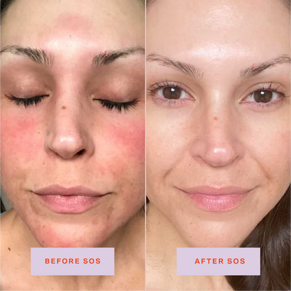 [Shared: Tower 28 Beauty SOS Daily Rescue Facial Spray Before + After Photo: left side of image (before) shows customer with redness on cheeks, forehead, and chin. Right side (after) of the image shows customer without redness on cheeks, forehead, and chin.]